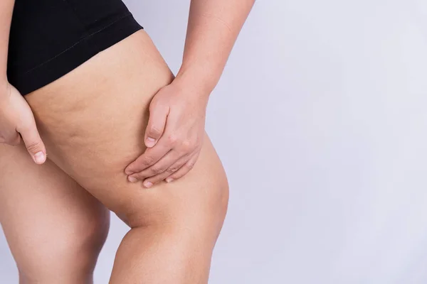 Female Holding Pushing Skin Legs Cellulite Orange Peel Treatment Disposal — Stock Photo, Image