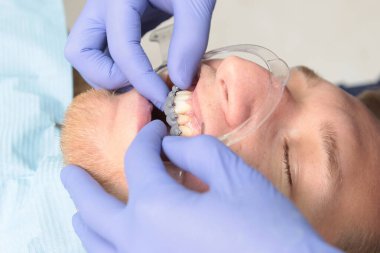 Diş teli takmak. Diş telleri yerleştirilirken ağız boşluğu için genişletici. Makro fotoğraf. Tanımlanamayan doktor. Sağlık hizmeti konsepti. Üst görünüm.