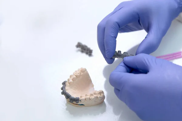 Ortodontisten Håller Tandställningen Sina Händer Innan Han Installerar Patienten Käkens — Stockfoto