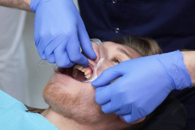 Dar bir ağız açıcı yerleştiriyorum. Diş telleriyle ısırık düzeltmeleri. Sağlık ve bakım konsepti. Üst görünüm.