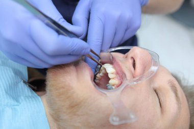 Genç bir adam diş teli takıyor. Diş yapısı ya da ısırık izi. Bir diş genişletici. Ellerinizi koruyucu eldivenlere koyun. Sağlık kavramı. Üst görünüm.