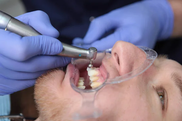 歯医者は患者の歯をきれいにする ブレースのインストールのための口腔の準備 誰も知らない医者 健康の概念 保護手袋の手 マクロ写真 — ストック写真