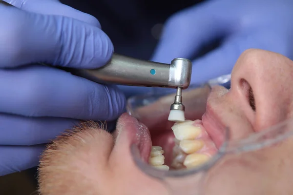 Dentista Pulisce Denti Del Paziente Preparazione Della Cavità Orale Installazione — Foto Stock