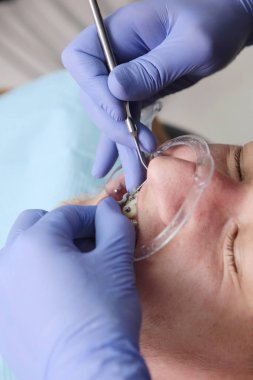 Diş kliniğinde maloklasyon ya da dengesizlik düzeltmesi. Bir ortodontist diş teli takar. Dikey fotoğraf. Ağız genişletici diş tellerinin yerleştirilmesidir. Üst görünüm.