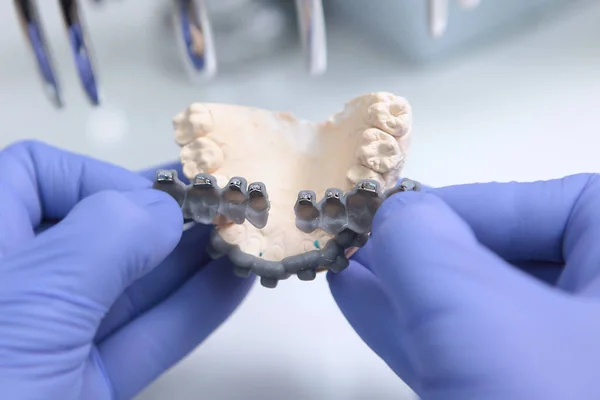 Doktorn Håller Tandställningen Tändernas Utformning Begreppet Hälsa Händerna Skyddshandskar Foto — Stockfoto