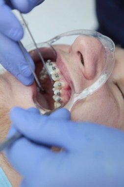Diş tellerinin yerleştirilmesi. Maloklasyon ya da dişçilik düzeltmesi. Bir ortodontistin ellerinde cımbız. Dikey fotoğraf. Ağız için genişlet. Üst görünüm.