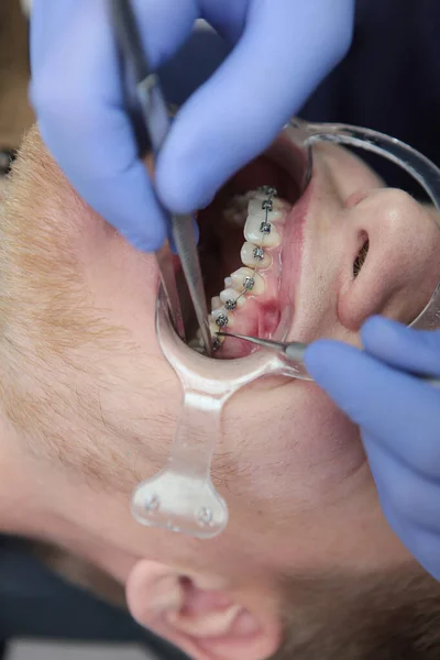 Korrigering Tänder Hos Person Med Ett Felaktigt Bett Montering Hängslen — Stockfoto