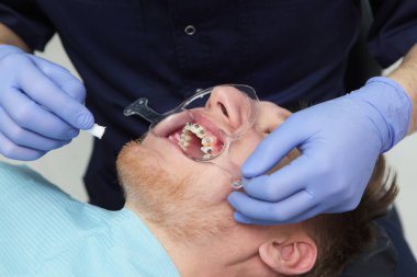 Diş tellerinin yerleştirilmesi. Maloklasyon ya da dişçilik düzeltmesi. Ortodontist randevusundaki genç bir adam. Ellerinizi koruyucu eldivenlere koyun. Üst görünüm.