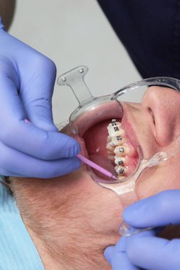 Diş tellerinin yerleştirilmesi. Maloklasyon ya da dişçilik düzeltmesi. Hasta ağzını açtı. Ellerinizi koruyucu eldivenlere koyun. Dikey fotoğraf. Üst görünüm.