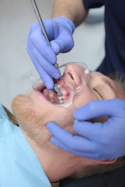 Doktor ortodontist diş teli takıyor. Diş düzeltmesinin makro fotoğrafı. Maloklasyon. Diş kliniğindeki fotoğraf. Dikey fotoğraf. Diş telleri yerleştirilirken ağız genişletici. Üst görünüm.