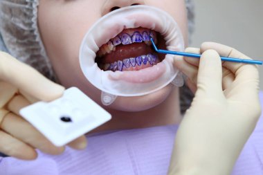 Diş hekimi, diş temizliği öncesinde hastaların dişlerine mor jel sürer. Dişeti ve sakız hastalıklarının önlenmesi. Ellerinizi koruyucu eldivenlere koyun. Makro fotoğraf