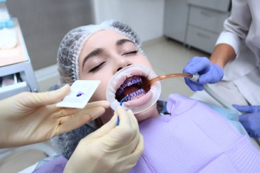 Profesyonel ağız temizliği ve diş temizliği. Dişlerine jel sürüyorum. Dişeti ve sakız hastalıklarının önlenmesi. Ağızda retraktör var..