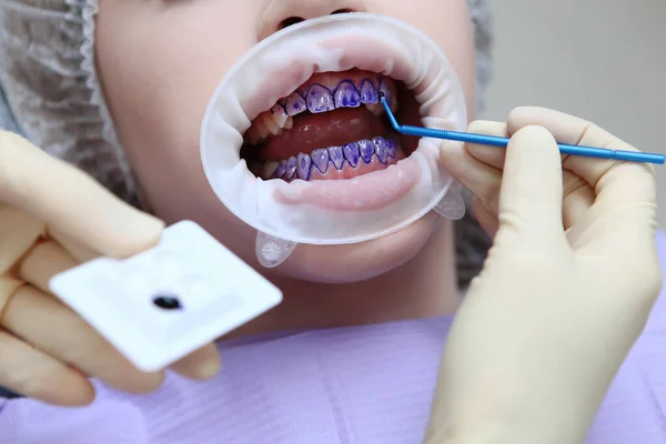 O dentista aplica o dente de um gel roxo nos dentes dos pacientes antes de uma limpeza dental profissional. Prevenção da cárie e doenças das gengivas. Mãos em luvas de proteção. Macro foto — Fotografia de Stock