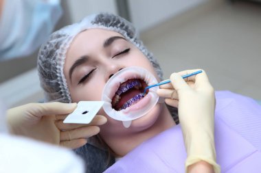 Profesyonel diş temizliği. Diş hekimi temizlemeden önce hastanın dişlerine mor bir jel sürer. Dişeti ve sakız hastalıklarının önlenmesi. Ellerinizi koruyucu eldivenlere koyun. Yukarıdan manzara. Boşluğu kopyala.