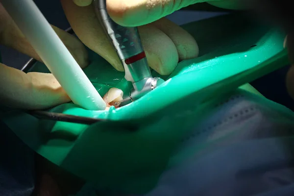 牙医从一颗婴儿的牙齿上去除蛀牙 口腔内宏观摄影 一般麻醉下的操作 — 图库照片