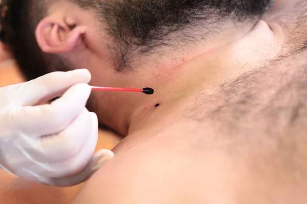 Cauterização Pele Após Remoção Laser Toupeiras Homem Médico Cosmetologista Conceito — Fotografia de Stock