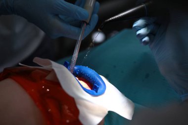 Ağız boşluğunu ağartılmaya hazırlayın. Ağızda retraktör. Hastanın ağzında diş aletleri. Diş kliniğinde hastanın ağzını aç. Yan görüş. Tanımlanamayan kişiler..