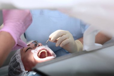 Diş implantı yerleştirilmiş. Ağzını aç. Ağızda retraktör var. Estetik dişçilik. Koruyucu eldivenli doktorun elleri..