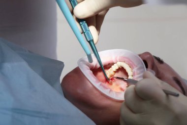 Doktor sakızdan bir parça kesecek. Bir parça sakız. Kemik büyütme. Ağzını aç. Makro fotoğraf. Hastanın diş etleri.