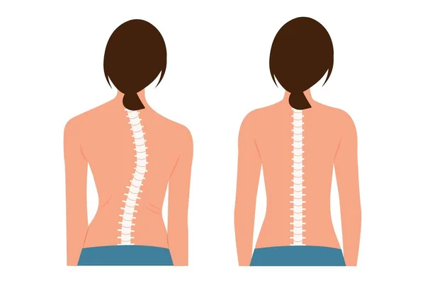 Buona Postura Cattiva Postura Chiropratica Prima Dopo Immagine Scoliosi Corpo — Vettoriale Stock