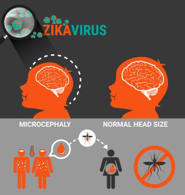 Bebek microcephaly ve Zika virüs olan gebelerin