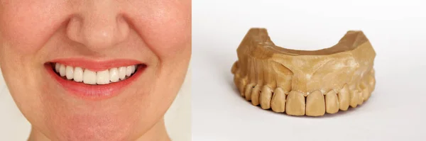 Sonrisa Zona Odontología Estética Modelo Yeso Mandíbula Artificial Con Chapas — Foto de Stock