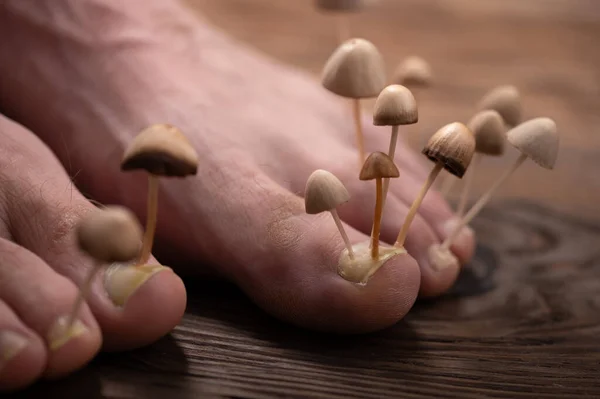 Fungi grow from the nail plates on the feet. Concept of nail fungus, skin and nail infections. Two legs with a fungus close-up in the background light.