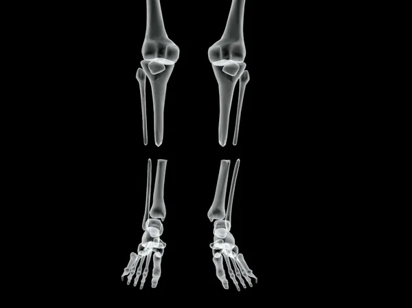 Image vectorielle par radiographie osseuse cassée — Image vectorielle