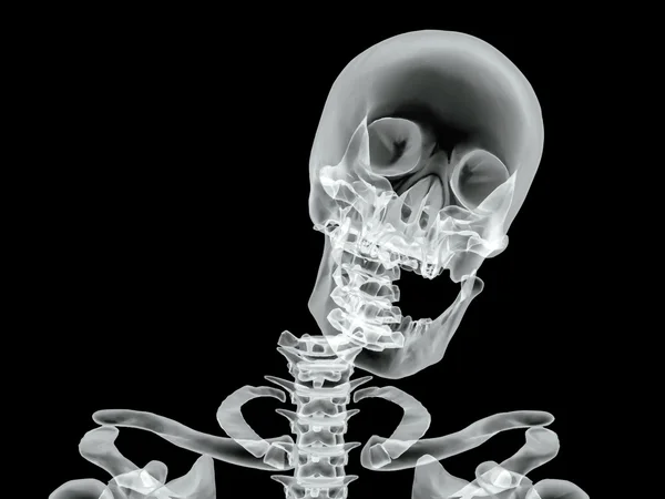 Image vectorielle par radiographie osseuse cassée — Image vectorielle