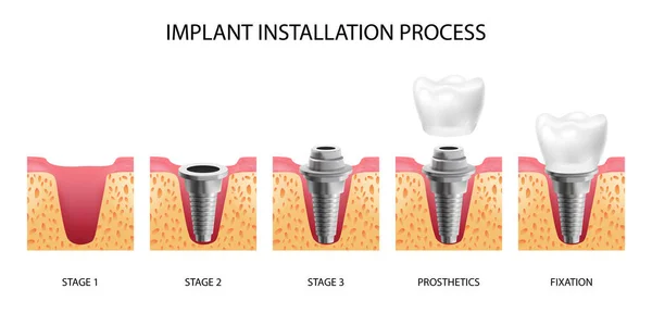 Einbau von Implantaten — Stockvektor