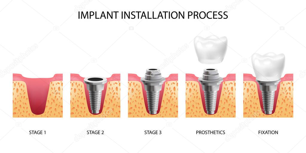 Implant Installation Stages