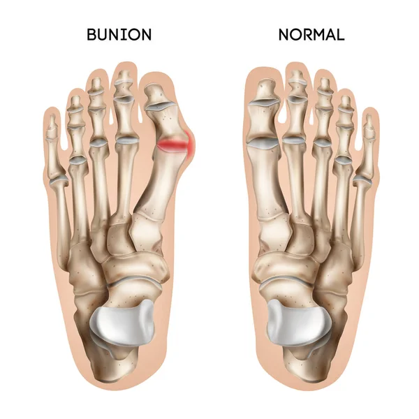 Voetstap Bunion Realistische Samenstelling — Stockvector