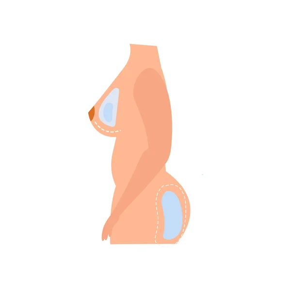 Ass Breast Augmentation Composition — стоковый вектор