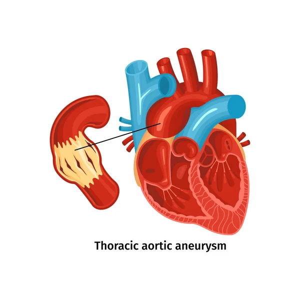 Kalp Hastalığı Anatomi Posteri — Stok Vektör