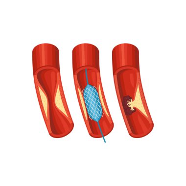 Aort Hastalıkları İllüstrasyonu