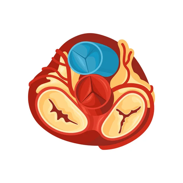 Anatomía cardíaca enferma — Vector de stock