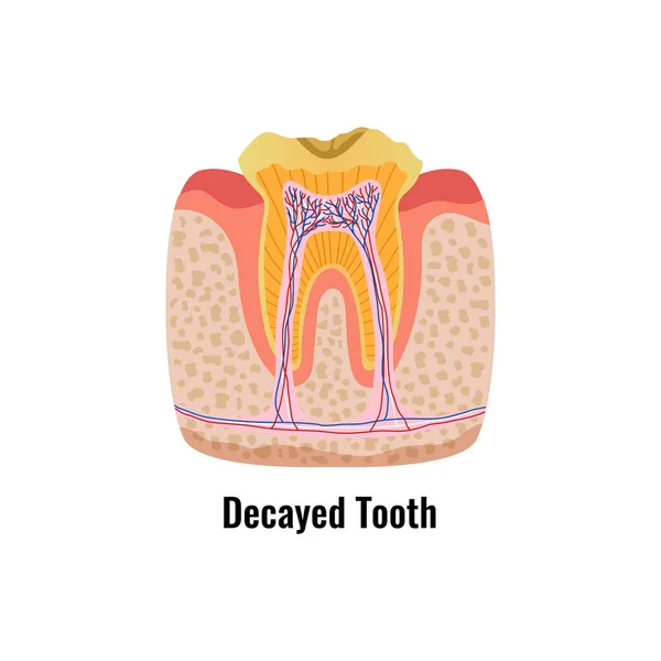 Poster dei denti decaduti — Vettoriale Stock