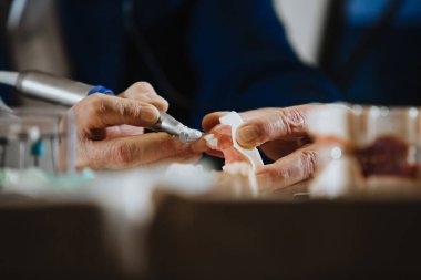 Bir diş teknisyeni hastanın çenesinden bir alçı çıkarır.