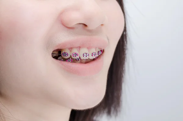Closeup teeth with braces — Stock Photo, Image