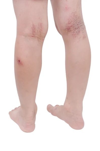 Τα πόδια με την πληγή από το ξύσιμο — Φωτογραφία Αρχείου