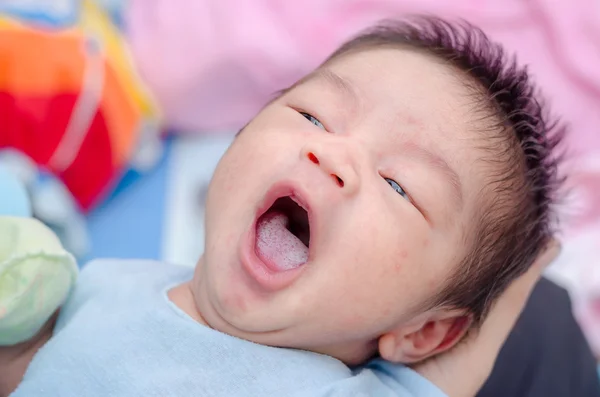 Newborn with candidiasis on tongue — Stock Photo, Image