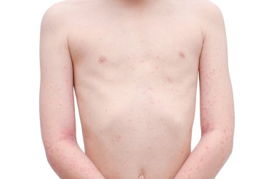 Young child skin with rash over white  clipart