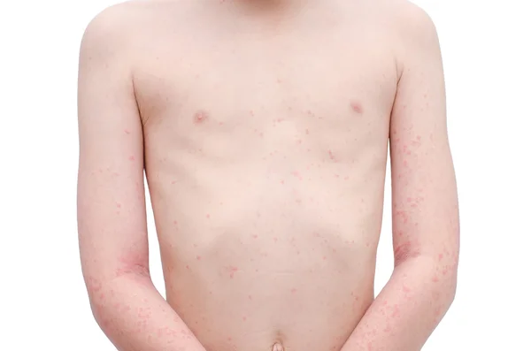 Young child skin with rash over white — Stock Photo, Image