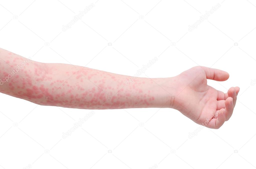 child arm skin with rash over white 