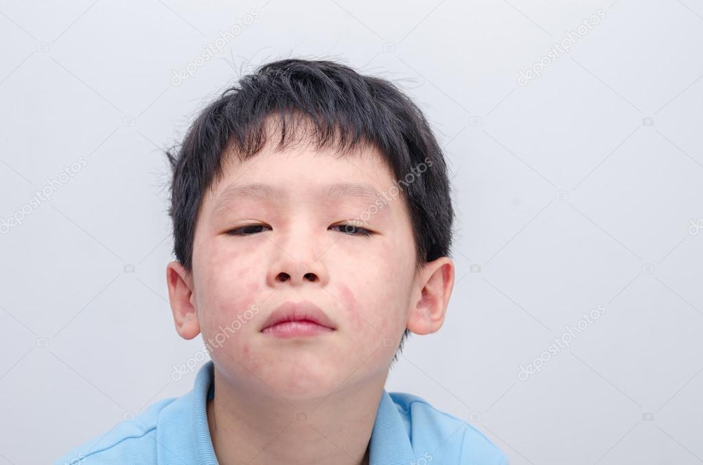 face of young asian boy with rash