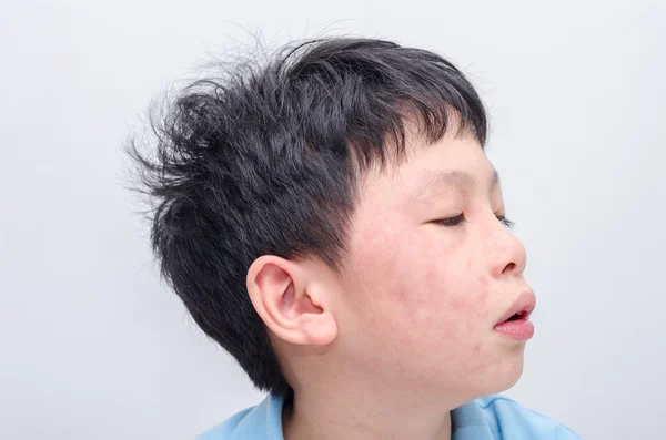 Ansikte av unga asiatiska pojke med utslag — Stockfoto