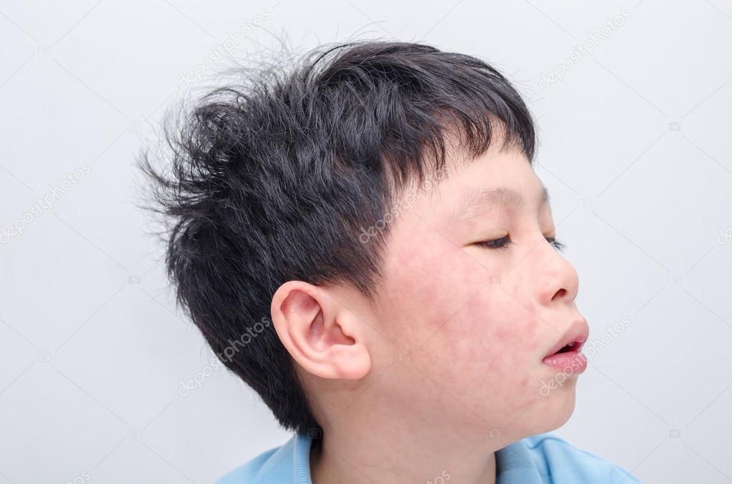 face of young asian boy with rash