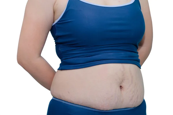 Woman in swim suit showing her stretch marks — Stock Photo, Image