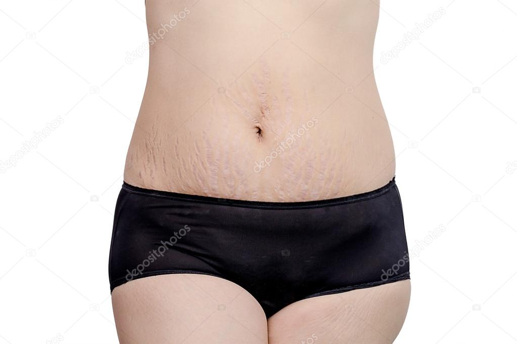 woman showing stretchmarks on her belly