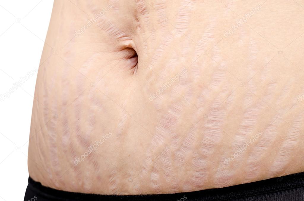 Stretch marks on  woman belly